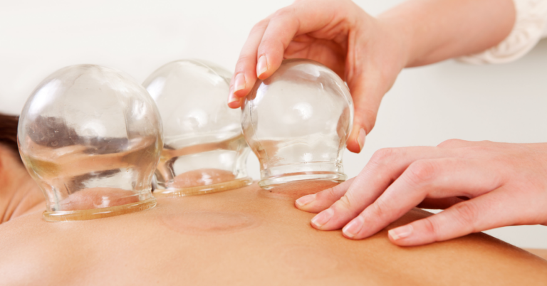 Exploring the Benefits of TCM Cupping Therapy in Singapore